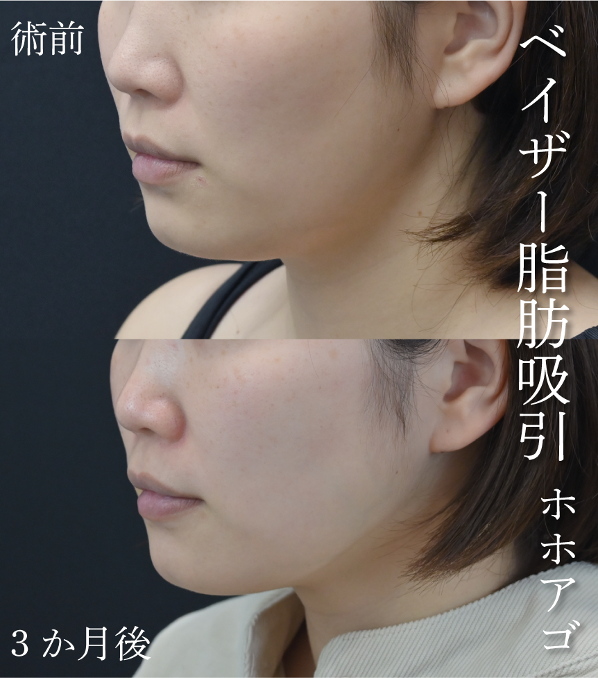 脂肪吸引の症例